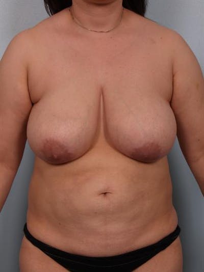 Power Assisted Liposuction Before & After Gallery - Patient 1310818 - Image 1