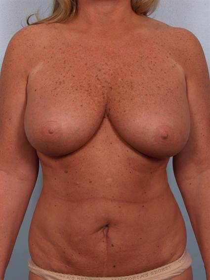 Image2 - Before image of Tummy Tuck in Beverly Hills by Dr. Cohen.