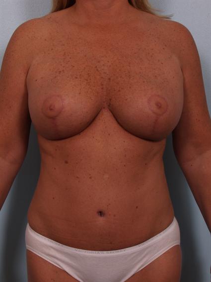 Image2 - After image of Tummy Tuck in Beverly Hills by Dr. Cohen.