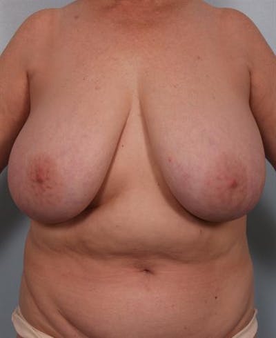 Breast Reduction Before & After Gallery - Patient 1310826 - Image 1