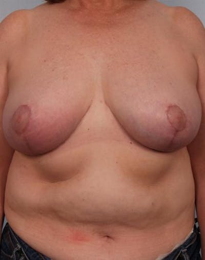 Breast Reduction Before & After Gallery - Patient 1310826 - Image 2