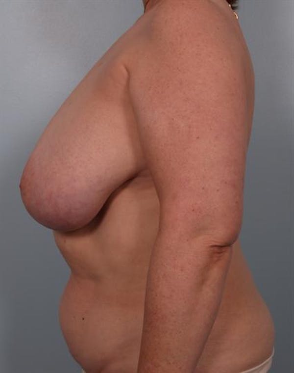 Breast Reduction Before & After Gallery - Patient 1310826 - Image 3
