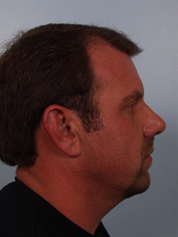 Facial Surgery Before & After Gallery - Patient 1310822 - Image 5
