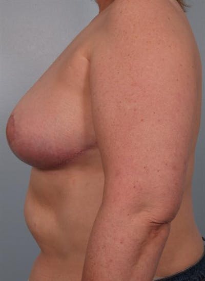 Breast Reduction Before & After Gallery - Patient 1310826 - Image 4