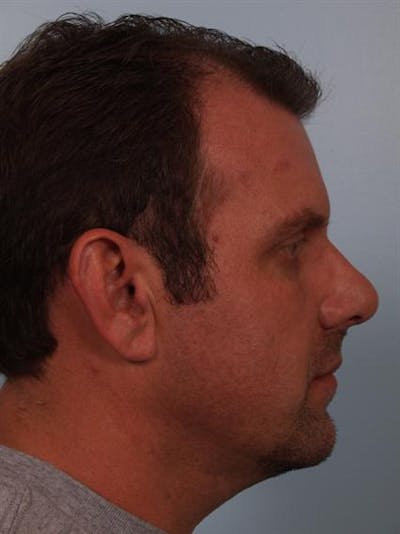 Facial Surgery Before & After Gallery - Patient 1310822 - Image 6
