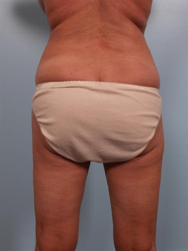 Tummy Tuck Before & After Gallery - Patient 1310824 - Image 7