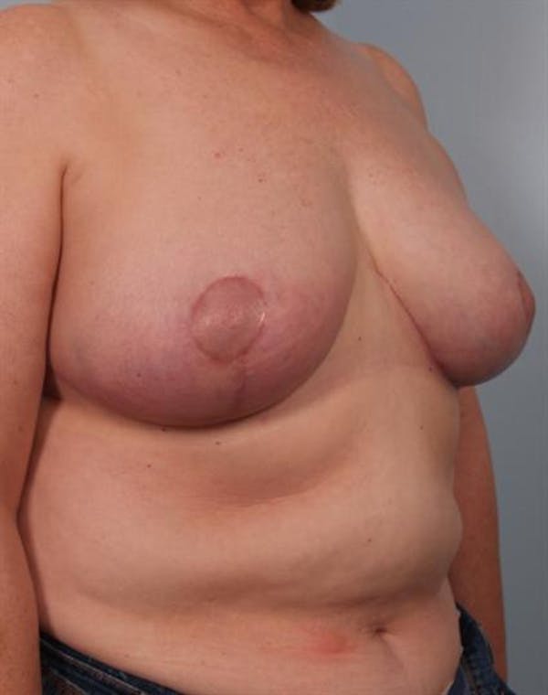 Breast Reduction Before & After Gallery - Patient 1310826 - Image 6