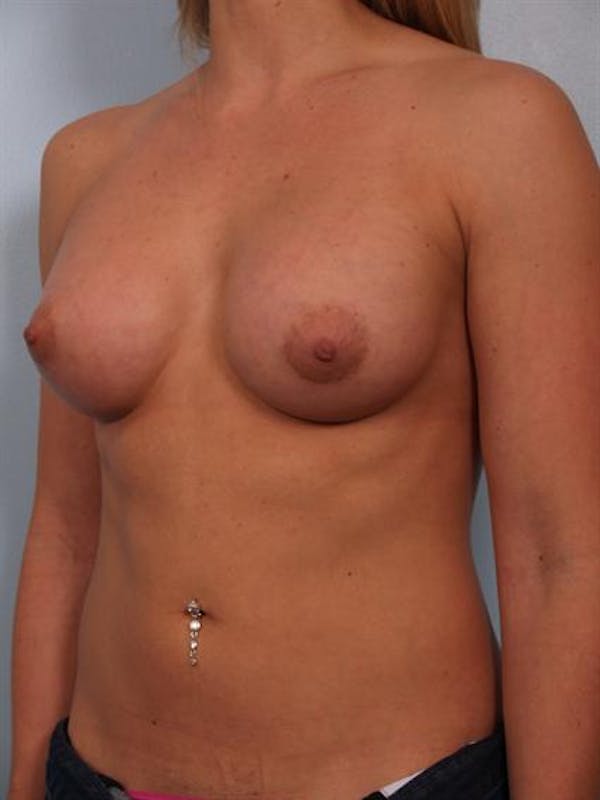 Breast Augmentation Before & After Gallery - Patient 1310834 - Image 2