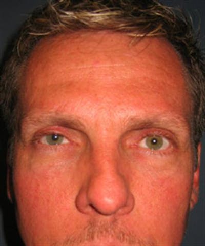 Facial Surgery Gallery - Patient 1310832 - Image 4