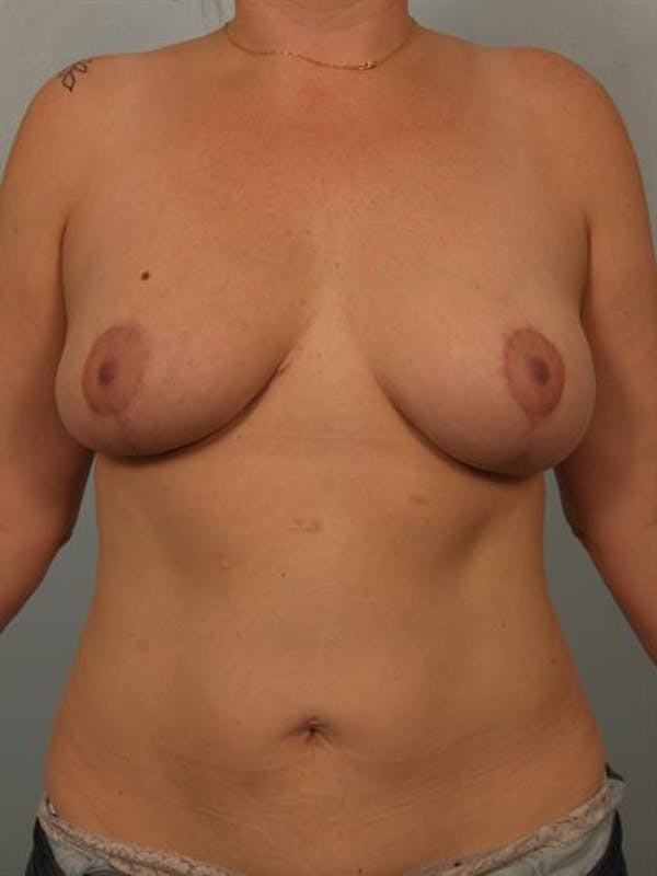 Breast Reduction Before & After Gallery - Patient 1310835 - Image 2