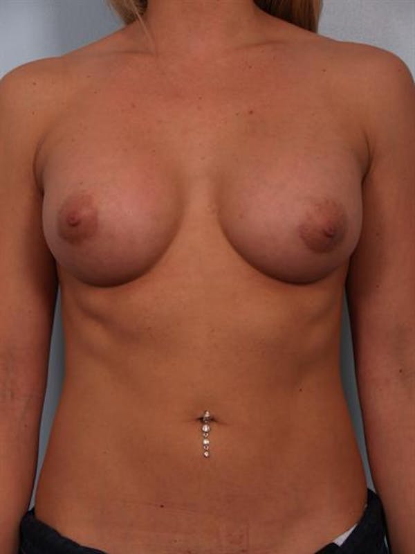 Breast Augmentation Gallery - Patient 1310834 - Image 4