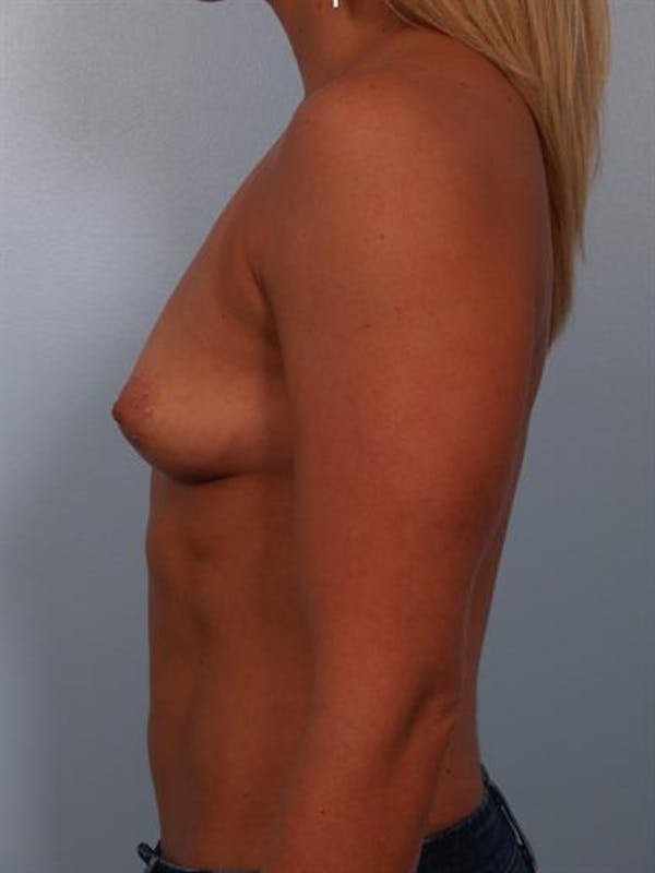 Breast Augmentation Before & After Gallery - Patient 1310834 - Image 5