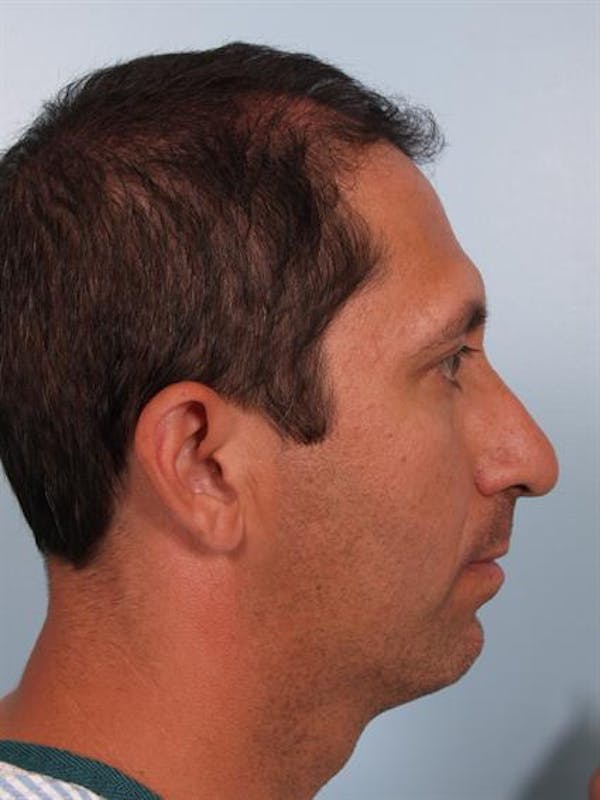 Facial Surgery Before & After Gallery - Patient 1310833 - Image 1