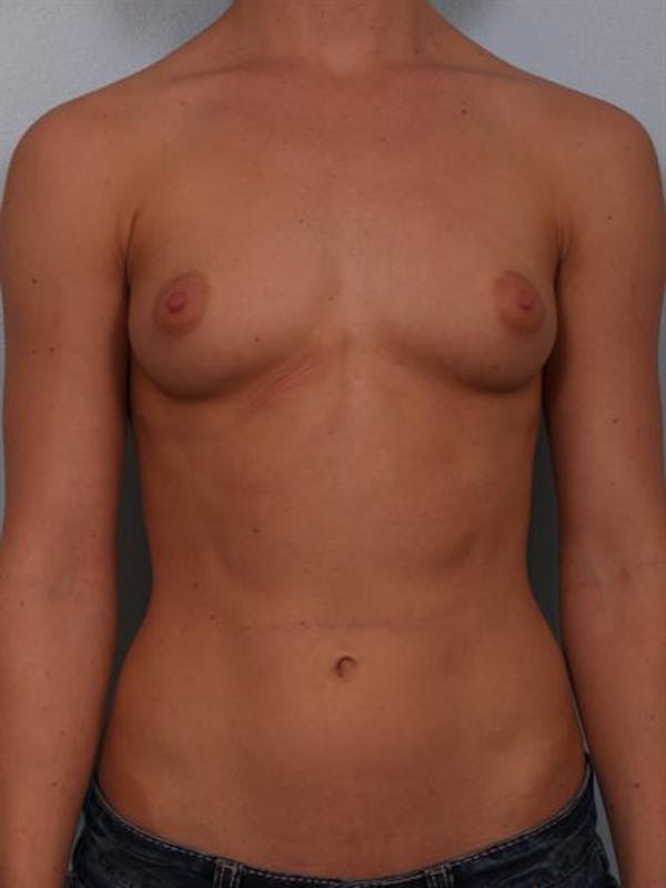 Breast Augmentation Before & After Gallery - Patient 1310846 - Image 1