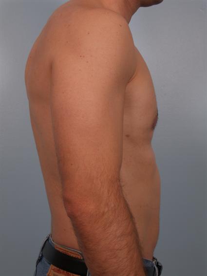 Gynecomastia After Photo Patient 1