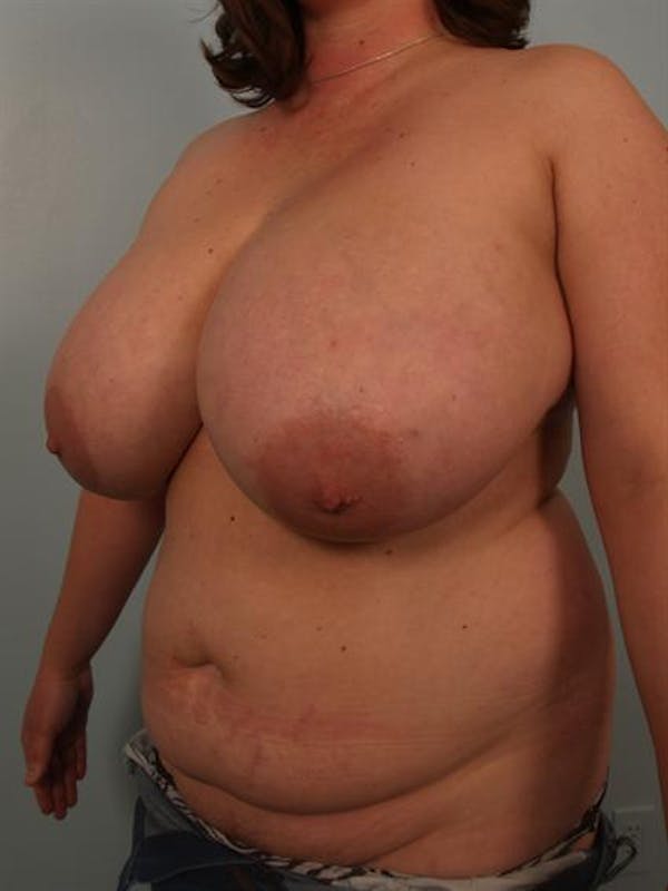 Breast Reduction Before & After Gallery - Patient 1310843 - Image 3
