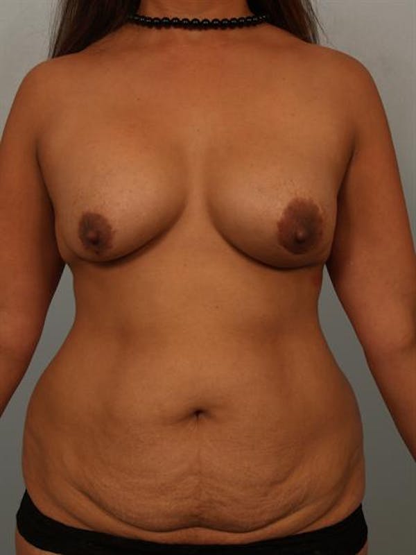 Breast Lift Gallery - Patient 1310844 - Image 1