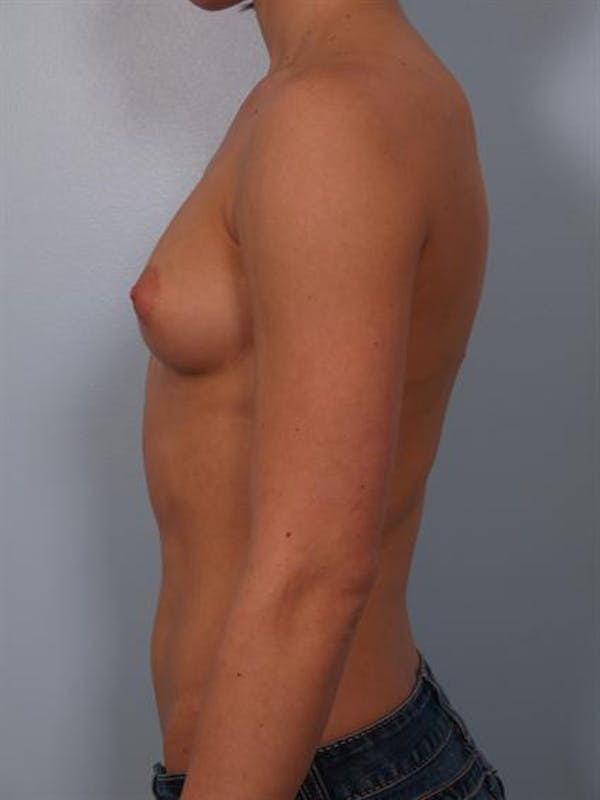 Breast Augmentation Before & After Gallery - Patient 1310846 - Image 3