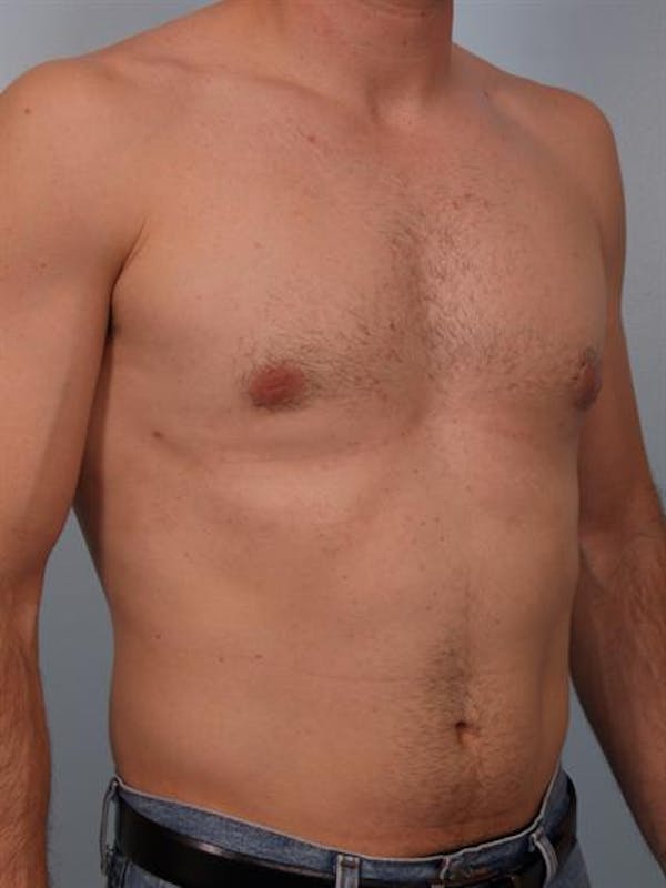 Male Liposuction Before & After Gallery - Patient 1310841 - Image 4