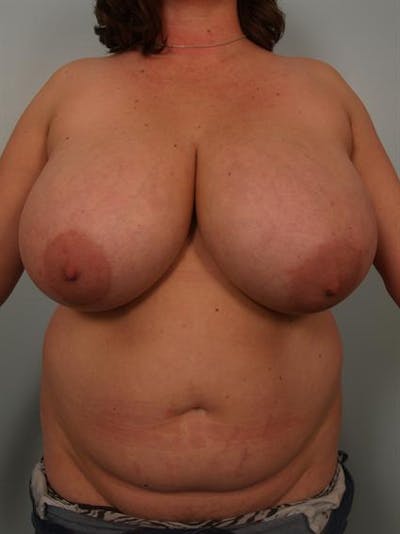 Breast Reduction Before & After Gallery - Patient 1310843 - Image 1