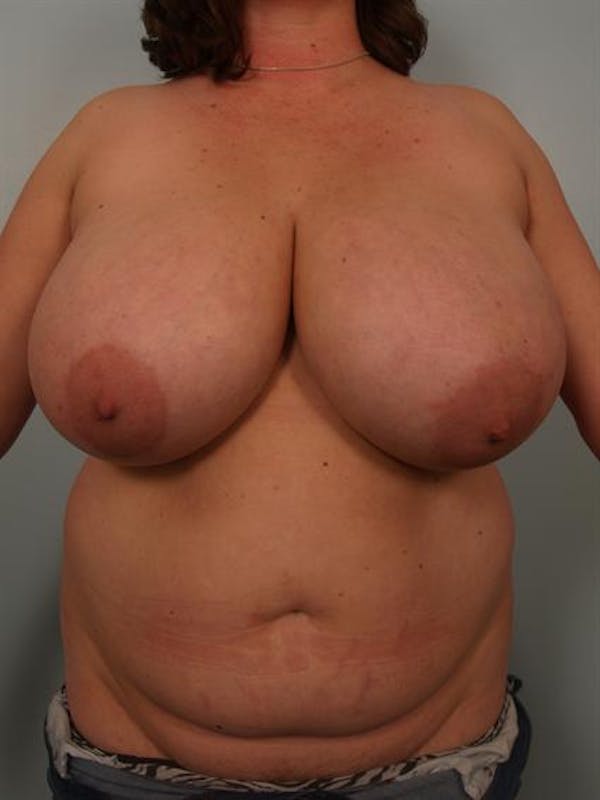 Breast Reduction Before & After Gallery - Patient 1310843 - Image 1