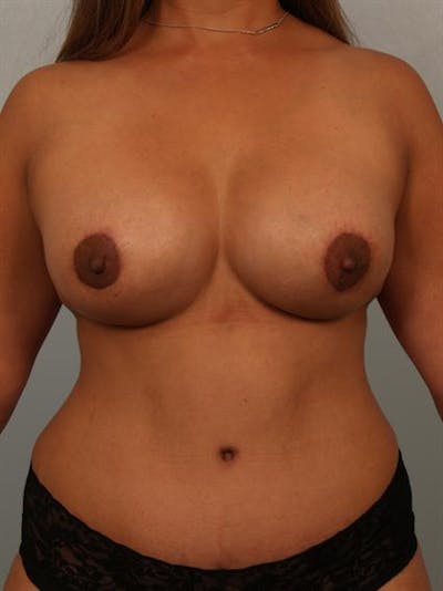 Breast Lift Before & After Gallery - Patient 1310844 - Image 2