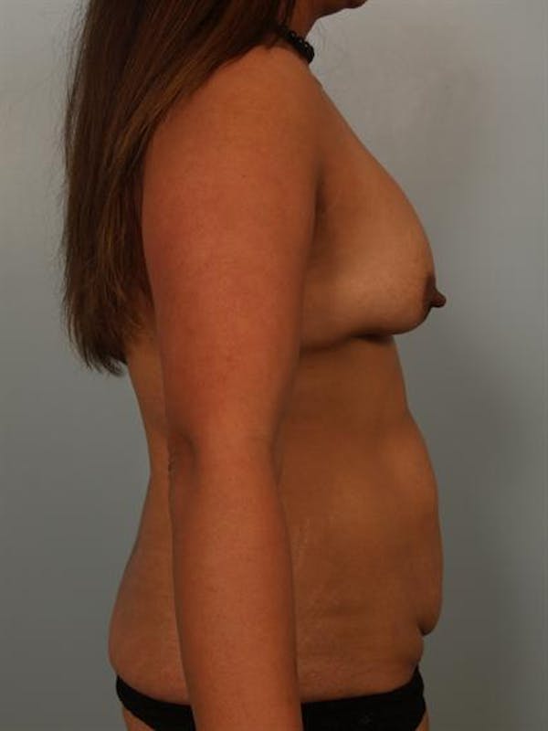 Breast Lift Before & After Gallery - Patient 1310844 - Image 3