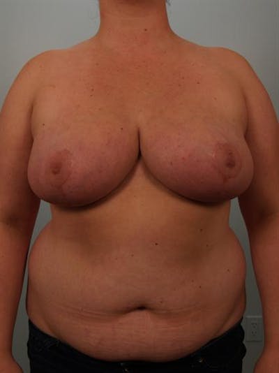 Breast Reduction Before & After Gallery - Patient 1310843 - Image 2