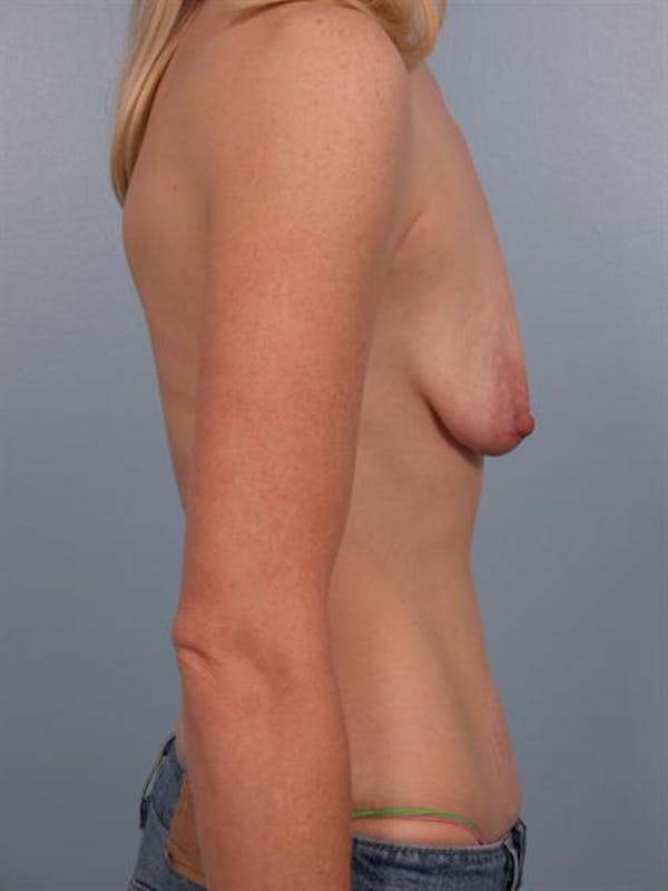 Complex Breast Revision Before & After Gallery - Patient 1310845 - Image 3