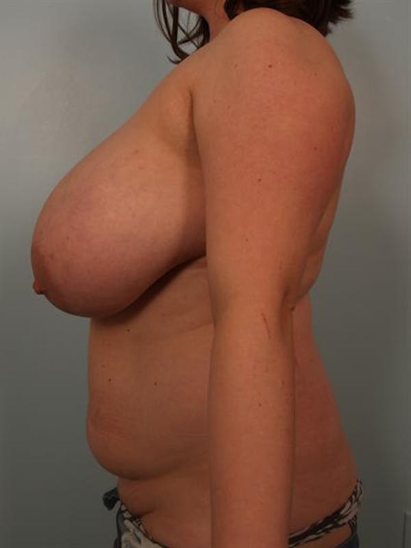 Breast Reduction Before & After Gallery - Patient 1310843 - Image 5