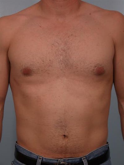 Male Liposuction Before & After Gallery - Patient 1310841 - Image 6