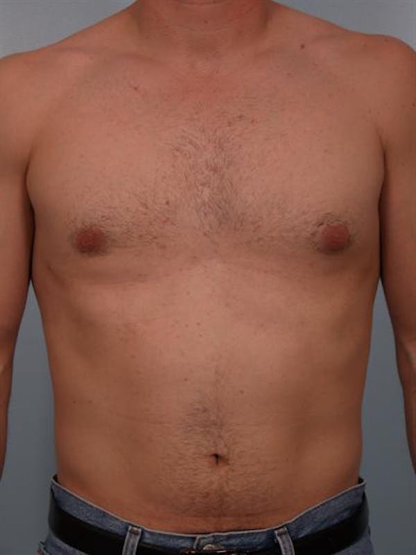 Male Liposuction Before & After Gallery - Patient 1310841 - Image 6