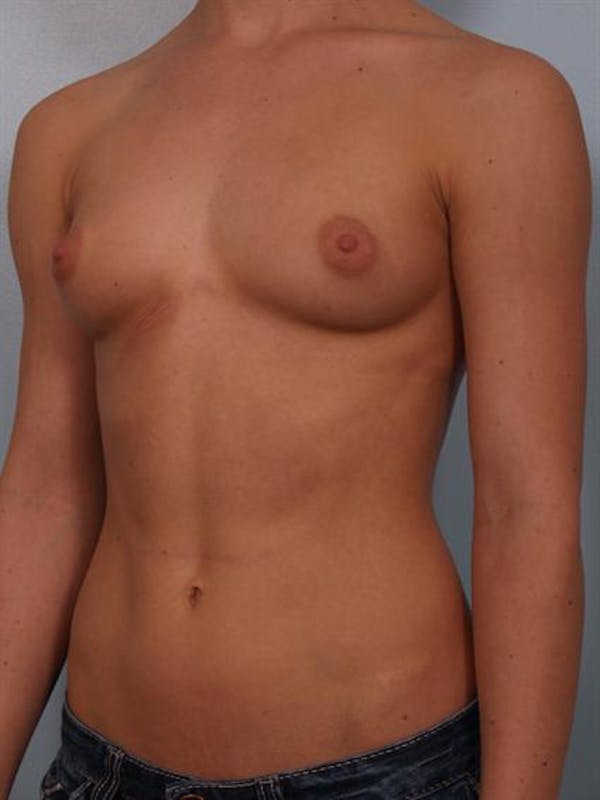 Breast Augmentation Before & After Gallery - Patient 1310846 - Image 5