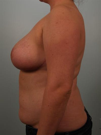 Breast Reduction Before & After Gallery - Patient 1310843 - Image 6