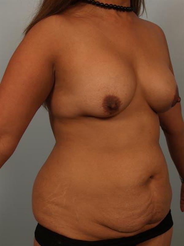 Breast Lift Gallery - Patient 1310844 - Image 5
