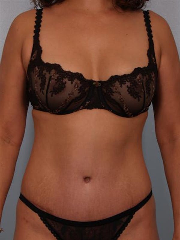Tummy Tuck Before & After Gallery - Patient 1310848 - Image 2
