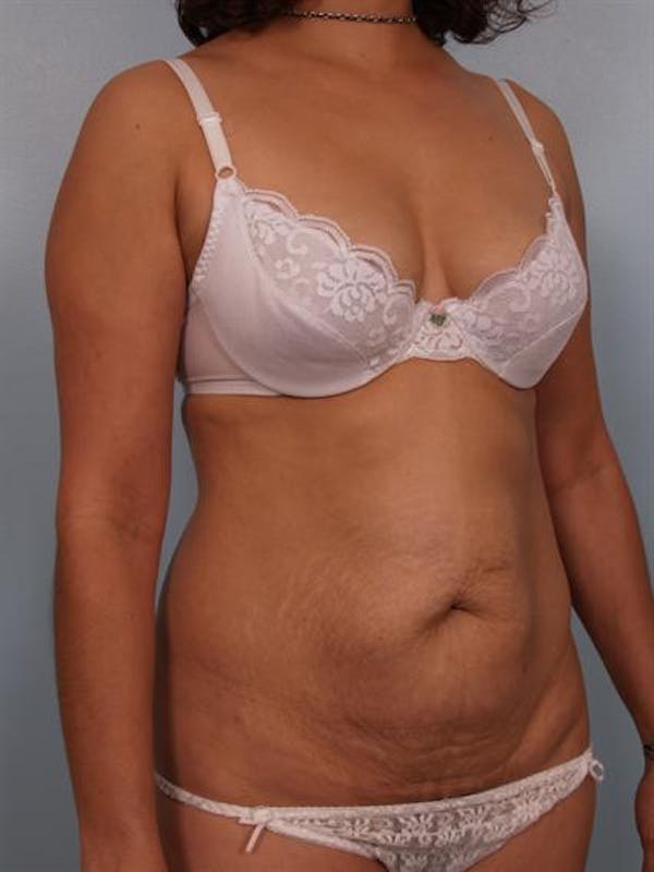 Tummy Tuck Before & After Gallery - Patient 1310848 - Image 3