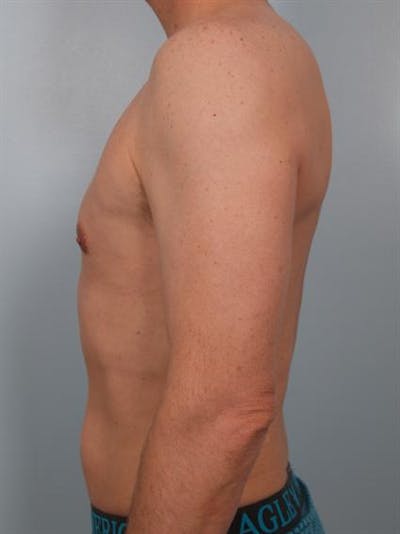 Male Liposuction Before & After Gallery - Patient 1310849 - Image 2