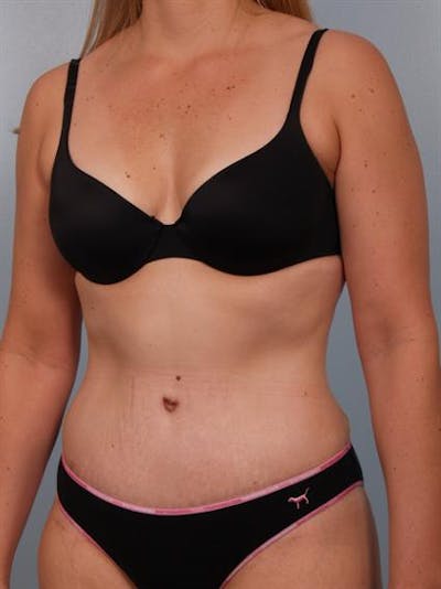 Power Assisted Liposuction Before & After Gallery - Patient 1310850 - Image 2