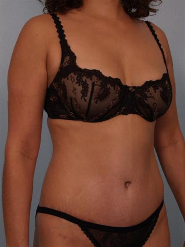 Tummy Tuck Before & After Gallery - Patient 1310848 - Image 4