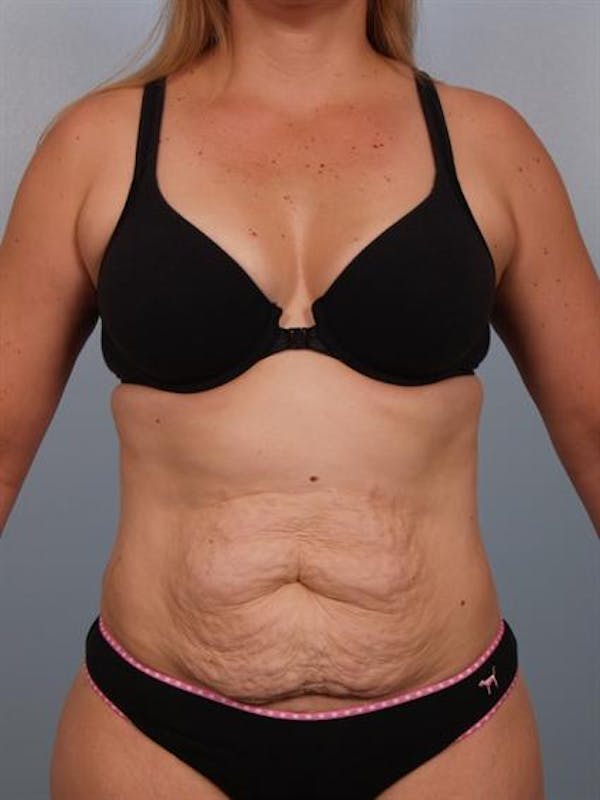 Power Assisted Liposuction Before & After Gallery - Patient 1310850 - Image 3