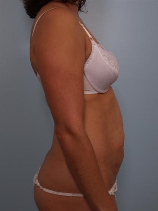 Tummy Tuck Before & After Gallery - Patient 1310848 - Image 5