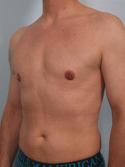 Male Liposuction Gallery - Patient 1310849 - Image 4