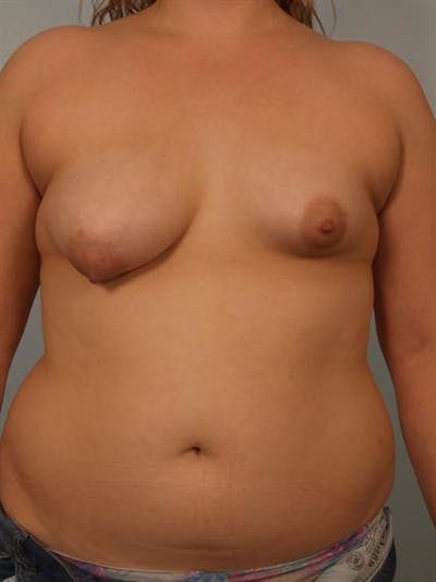Breast Augmentation Before & After Gallery - Patient 1310854 - Image 1