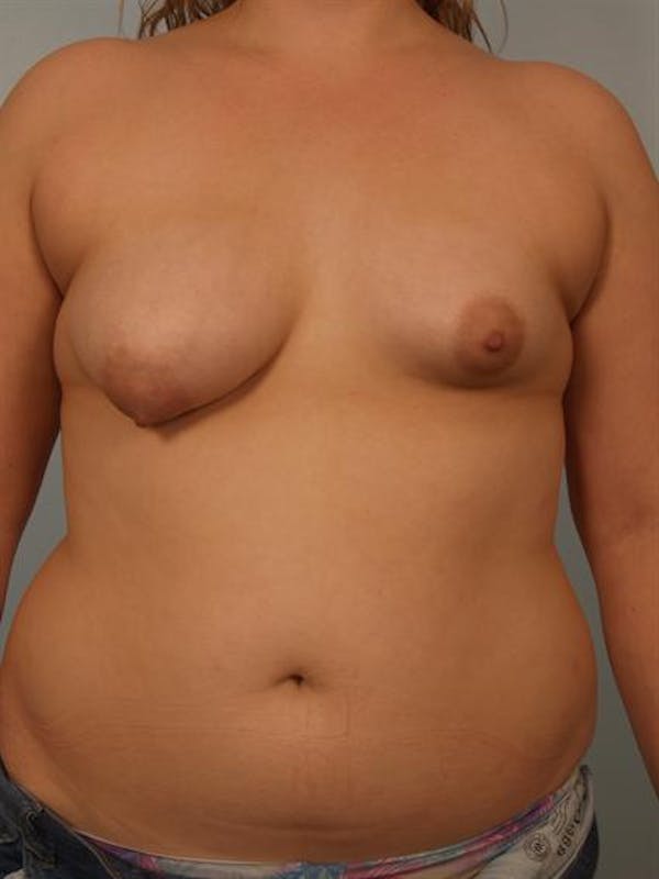 Breast Augmentation Gallery - Patient 1310854 - Image 1