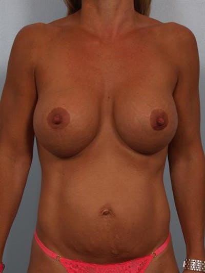 Breast Lift Before & After Gallery - Patient 1310853 - Image 2