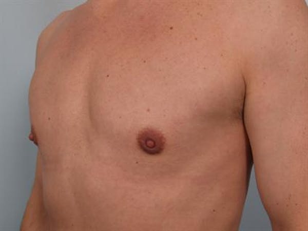 Male Liposuction Gallery - Patient 1310849 - Image 6