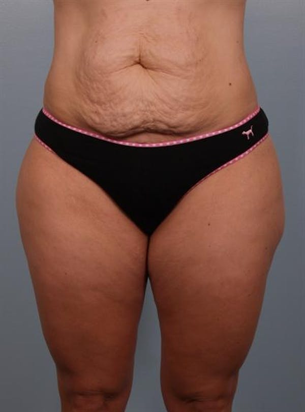 Power Assisted Liposuction Before & After Gallery - Patient 1310850 - Image 7