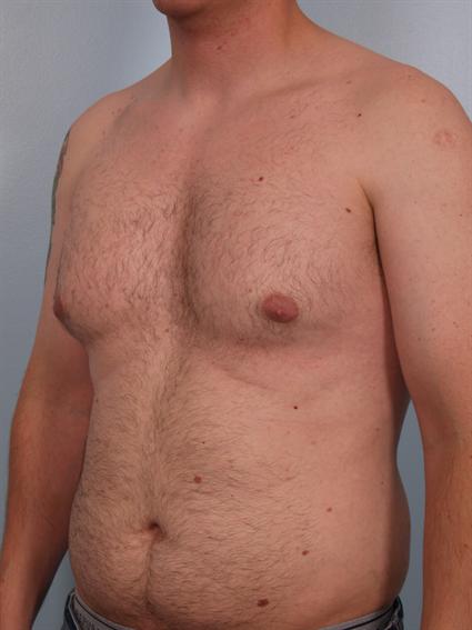 Gynecomastia Before Photo Patien 2