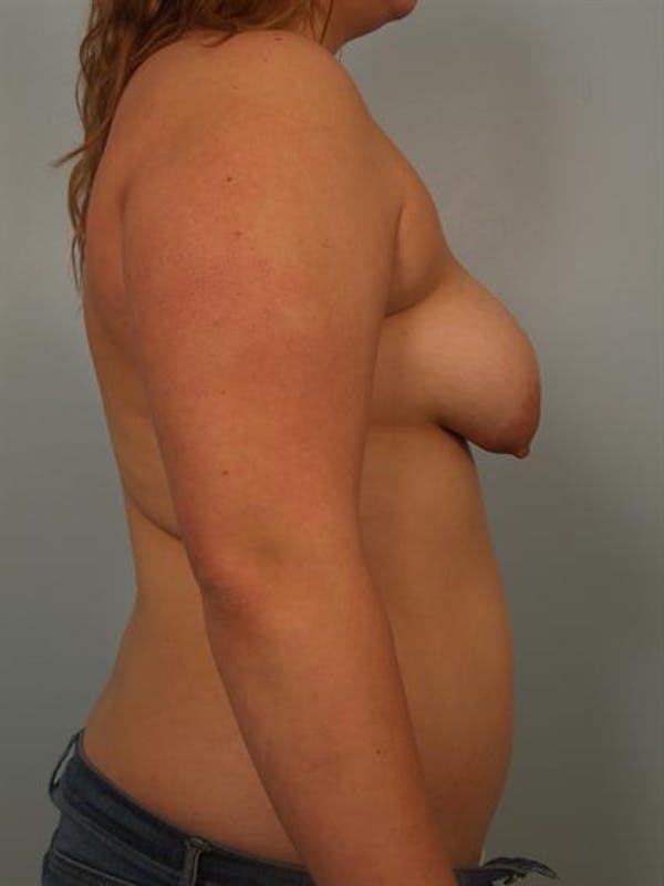 Breast Augmentation Before & After Gallery - Patient 1310854 - Image 5